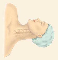 Anterior Cervical Discectomy w/ Fusion