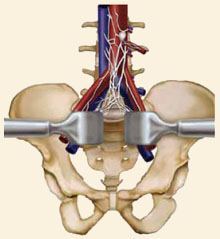 Anterior Lumbar Interbody Fusion (ALIF)