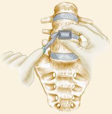 Anterior Lumbar Interbody Fusion (ALIF)