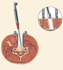 prestige cervical disc surgery