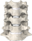 prestige cervical disc surgery