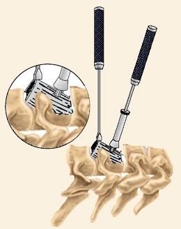 Cervical Corpectomy