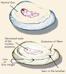 Degenerative Disc Disease (DDD)