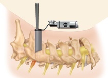 Cervical Foraminotomy