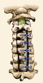 Cervical Laminoplasty