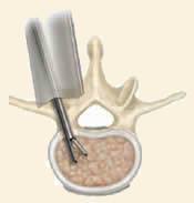 Lumbar Microdiscectomy