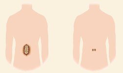 Transforaminal Lumbar Interbody Fusion (PLIF)