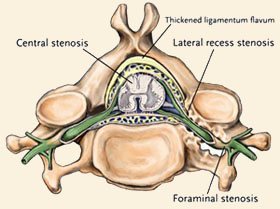 Stenosis