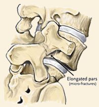 Spondylolisthesis