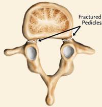 Spondylolisthesis